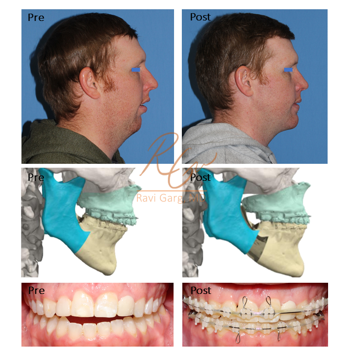 Orthognathic Jaw Surgery Before and After - Case 1