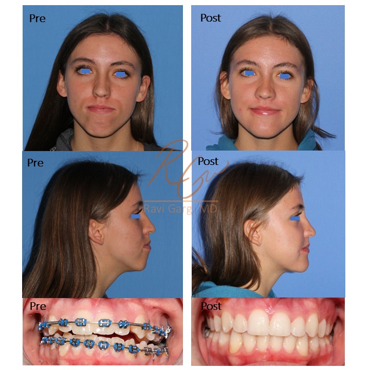 Orthognathic Jaw Surgery Before and After - Case 2